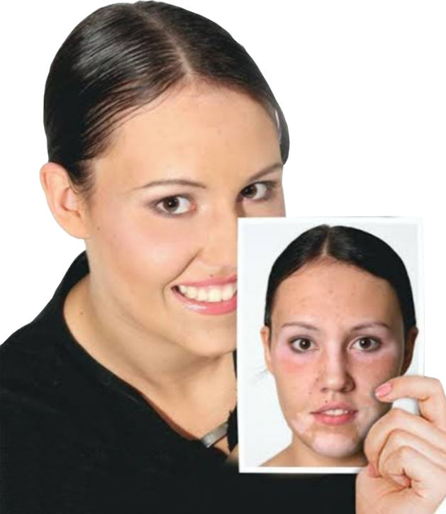 vitiligo facts and figures